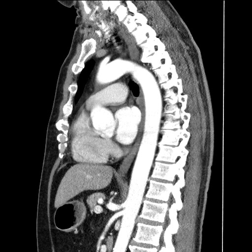 Adenocarcinoma of the lung (Radiopaedia 59871-67325 Sagittal C+ arterial phase 55).jpg