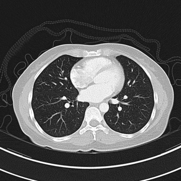 Adenocystic carcinoma of the trachea (Radiopaedia 47677-52525 Axial lung window 58).jpg