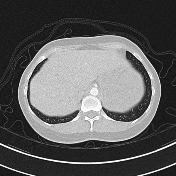 Adenocystic carcinoma of the trachea (Radiopaedia 47677-52525 Axial lung window 74).jpg