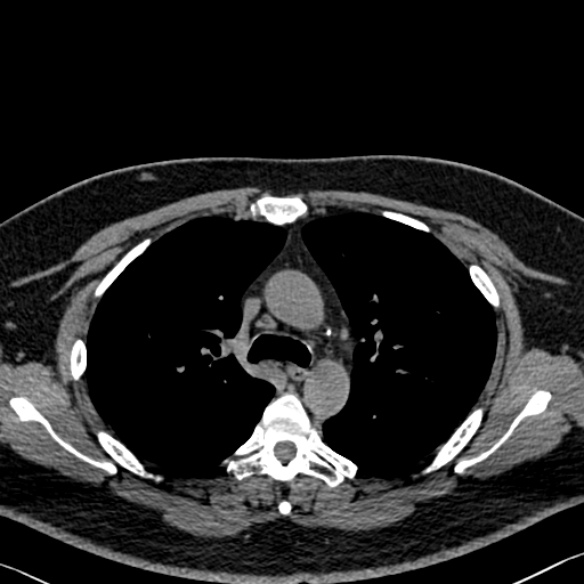 Adenoid cystic carcinoma of the trachea (Radiopaedia 49042-54137 Axial non-contrast 117).jpg