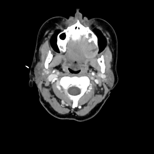 File:Adenoid cystic tumor of palate (Radiopaedia 46980-51518 Axial C+ delayed 29).png