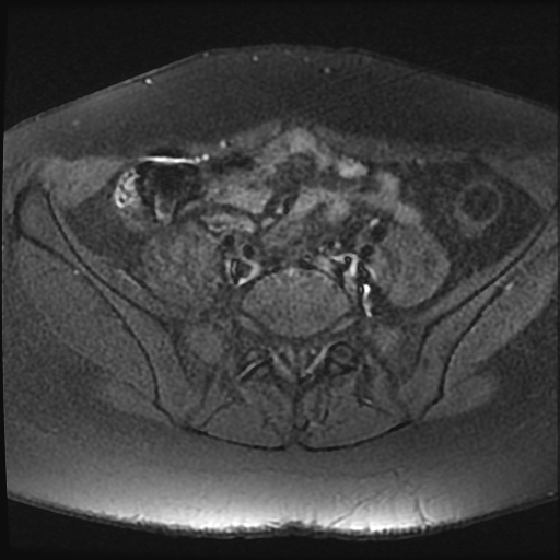 File:Adenomyosis-scar endometriosis (Radiopaedia 65863-75022 Axial T1 fat sat 1).jpg
