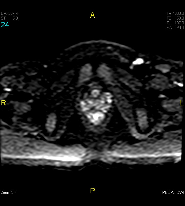 Adenomyosis (Radiopaedia 43504-46889 Axial DWI 24).jpg