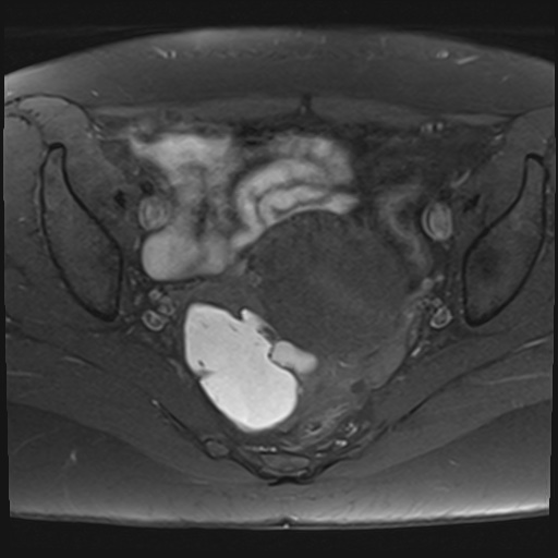 File:Adenomyosis and endometriotic cysts (Radiopaedia 82300-96367 Axial T1 fat sat 14).jpg