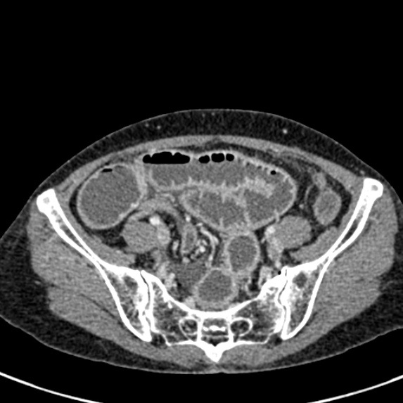 File:Adhesional small bowel obstruction (Radiopaedia 48397-53305 Axial C+ portal venous phase 70).jpg