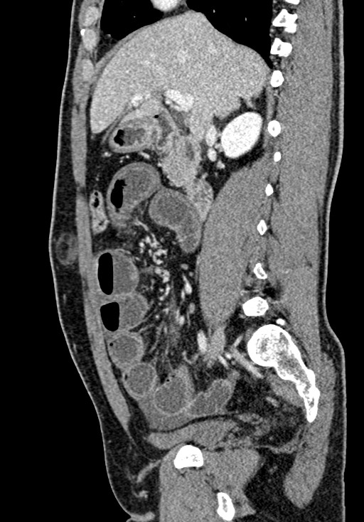 Adhesional small bowel obstruction (Radiopaedia 58900-66131 Sagittal C+ portal venous phase 99).jpg