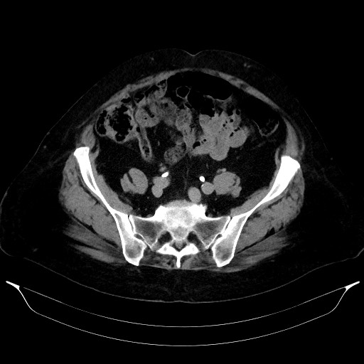 Adrenal cortical carcinoma (Radiopaedia 64017-72769 Axial C+ delayed 57).jpg