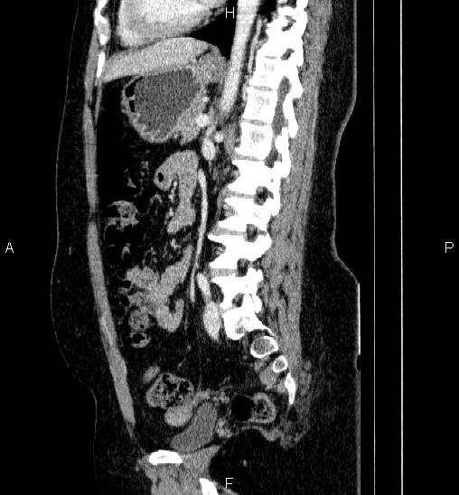 Adrenal cortical carcinoma (Radiopaedia 84882-100379 Sagittal C+ portal venous phase 53).jpg
