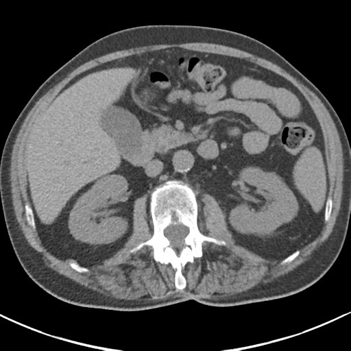 File:Adrenal hematoma (Radiopaedia 44334-47967 Axial non-contrast 40).png