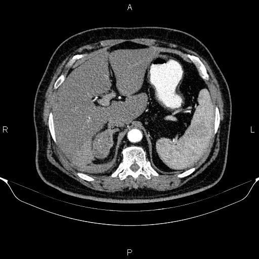 Adrenal hemorrhage (Radiopaedia 62622-70916 Axial C+ arterial phase 82).jpg