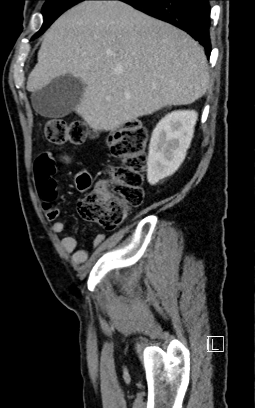 Adrenal lymphoma (Radiopaedia 73730-84529 Sagittal C+ portal venous phase 22).jpg
