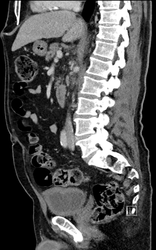 Adrenal lymphoma (Radiopaedia 73730-84529 Sagittal C+ portal venous phase 55).jpg
