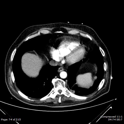 Adrenal metastasis (Radiopaedia 78425-91079 Axial C+ arterial phase 4).jpg