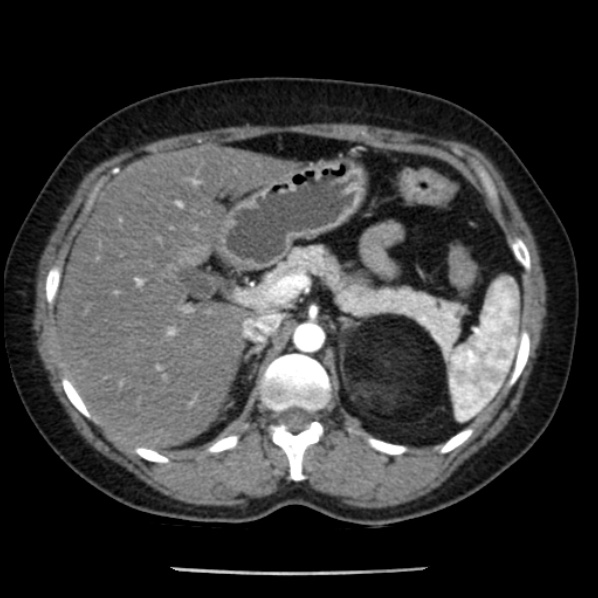 Adrenal myelolipoma (Radiopaedia 43401-46759 Axial C+ arterial phase 30).jpg