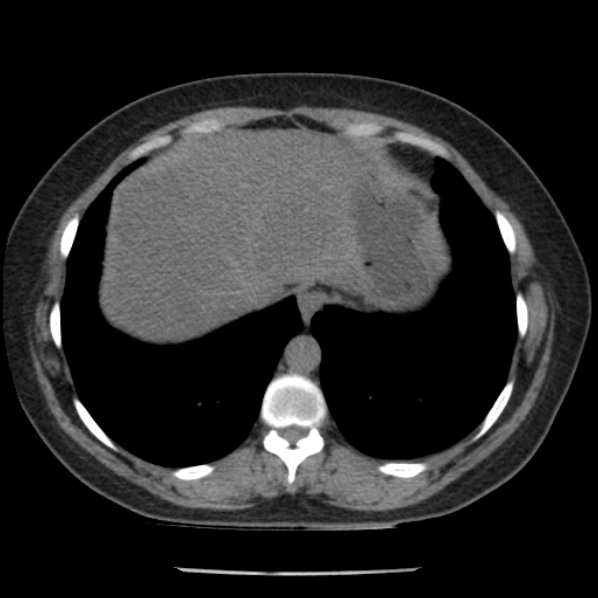 Adrenal myelolipoma (Radiopaedia 43401-46759 Axial non-contrast 10).jpg