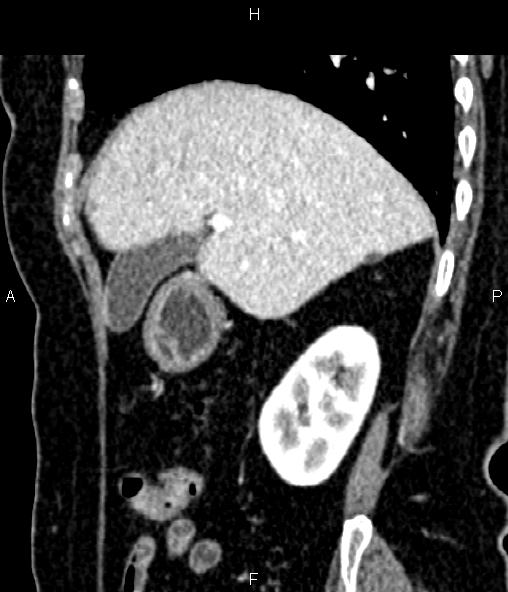 Adrenal myelolipoma (Radiopaedia 82742-96986 Sagittal renal cortical phase 35).jpg