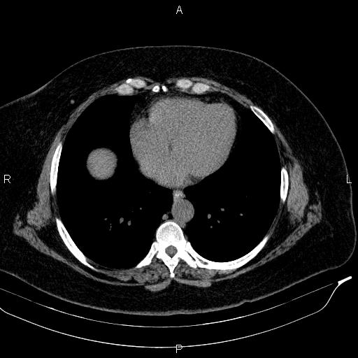 File:Adrenal myelolipoma (Radiopaedia 84319-99617 Axial With oral contrast 14).jpg