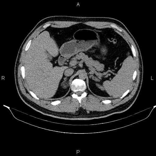 Adrenal myelolipoma (Radiopaedia 84321-99619 Axial non-contrast 32).jpg