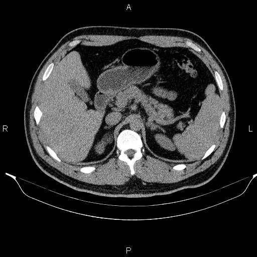 File:Adrenal myelolipoma (Radiopaedia 84321-99619 Axial non-contrast 33).jpg
