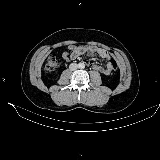 File:Adrenal myelolipoma (Radiopaedia 87794-104246 Axial renal cortical phase 57).jpg