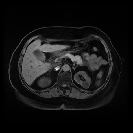 Adrenal myelolipoma - MRI (Radiopaedia 83249-97646 Axial T1 fat sat 31).jpg