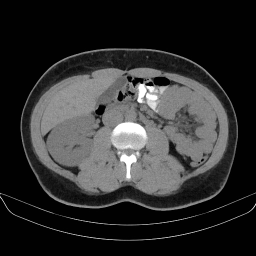 Adrenal myelolipoma - bilateral (Radiopaedia 74805-85810 Axial non-contrast 38).jpg