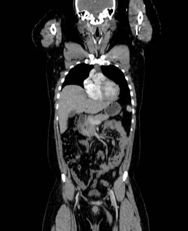 Adrenocortical carcinoma (Radiopaedia 80134-93438 Coronal C+ portal venous phase 61).jpg
