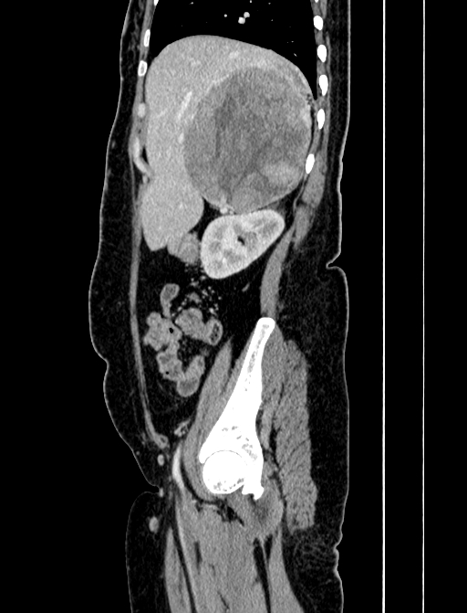 Adrenocortical carcinoma (Radiopaedia 87281-103569 Sagittal C+ portal venous phase 65).jpg