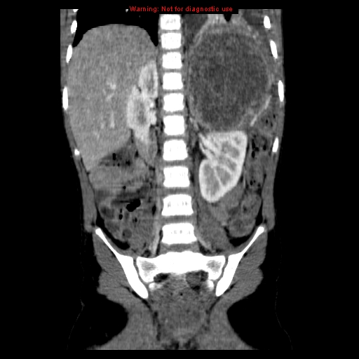 File:Adrenocortical carcinoma (Radiopaedia 9449-10131 Coronal C+ portal venous phase 11).jpg