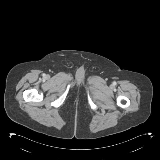 Adult ileal intussusception with secondary obstruction (Radiopaedia 30395-31051 Axial C+ portal venous phase 87).jpg