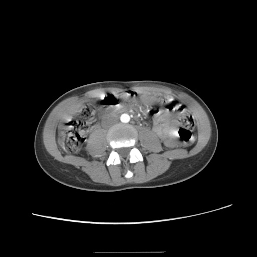 Adult polycystic kidney disease (Radiopaedia 48845-53876 Axial renal cortical phase 39).jpg