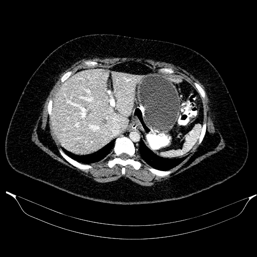 File:Afferent loop syndrome - secondary to incarcerated trocar site hernia (Radiopaedia 82959-97305 Axial C+ portal venous phase 48).jpg