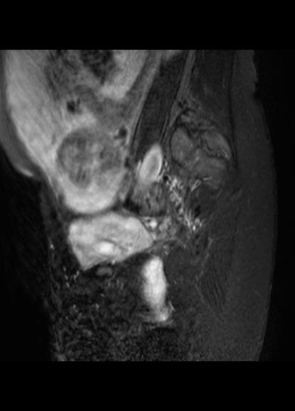 File:Aggressive angiomyxoma of the pelvis and perineum (Radiopaedia 59162-66479 Sagittal T2 fat sat 4).jpg