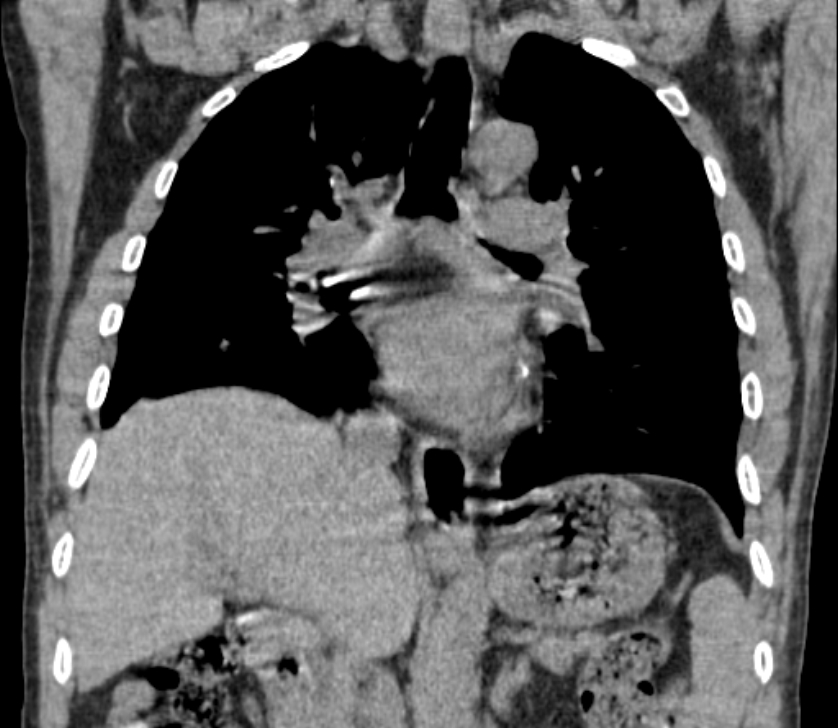 Airway foreign body in adult (Radiopaedia 85907-101779 Coronal liver window 144).jpg