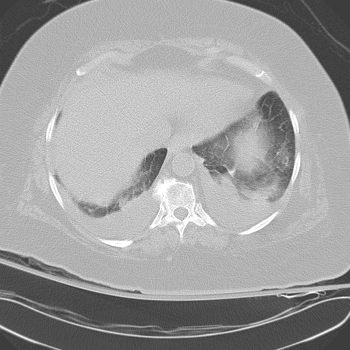 All trans retinoic acid (ATRA) syndrome (Radiopaedia 38212-40229 Axial lung window 43).jpg