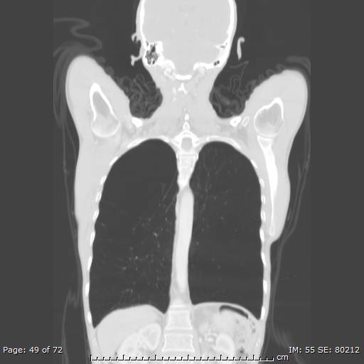 Alpha-1-antitrypsin deficiency (Radiopaedia 50561-55987 Coronal lung window 47).jpg