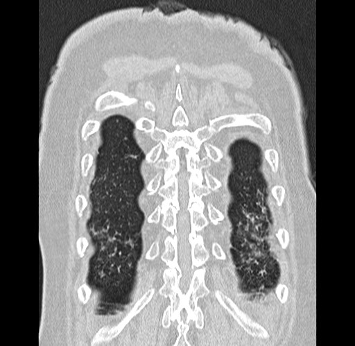 Alpha-1-antitrypsin deficiency (Radiopaedia 72058-82557 Coronal lung window 93).jpg
