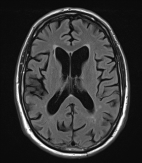 File:Alzheimer's disease- with Gerstmann syndrome and dressing apraxia (Radiopaedia 54882-61150 Axial FLAIR 16).png