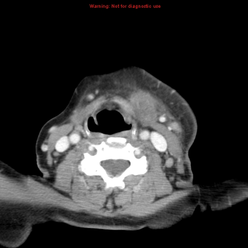 File:Ameloblastoma (Radiopaedia 27437-27631 A 60).jpg