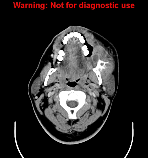 File:Ameloblastoma (Radiopaedia 33126-34164 B 5).jpg