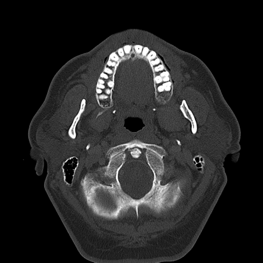 Ameloblastoma (Radiopaedia 38520-40623 Axial bone window 22).png