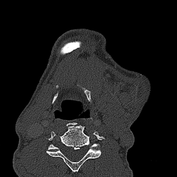 Ameloblastoma (Radiopaedia 51921-57766 Axial bone window 17).jpg
