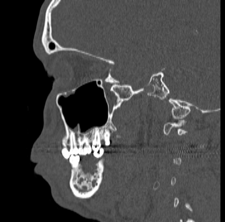 Ameloblastoma (Radiopaedia 77750-89997 Sagittal bone window 35).jpg