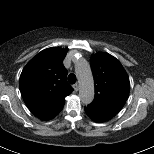 File:Amiodarone-induced pulmonary fibrosis (Radiopaedia 82355-96460 Axial non-contrast 21).jpg