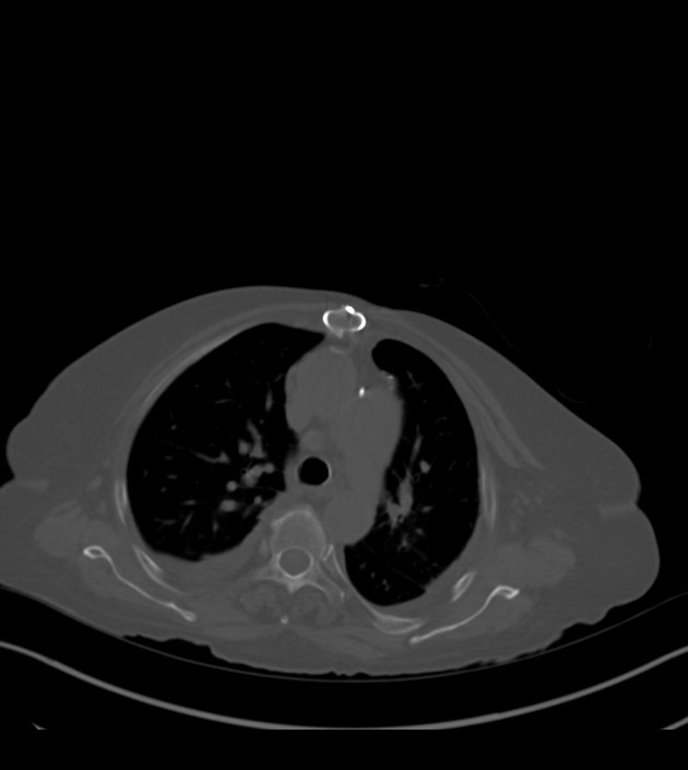 Amiodarone deposition in the liver (Radiopaedia 77587-89780 Axial bone window 28).jpg