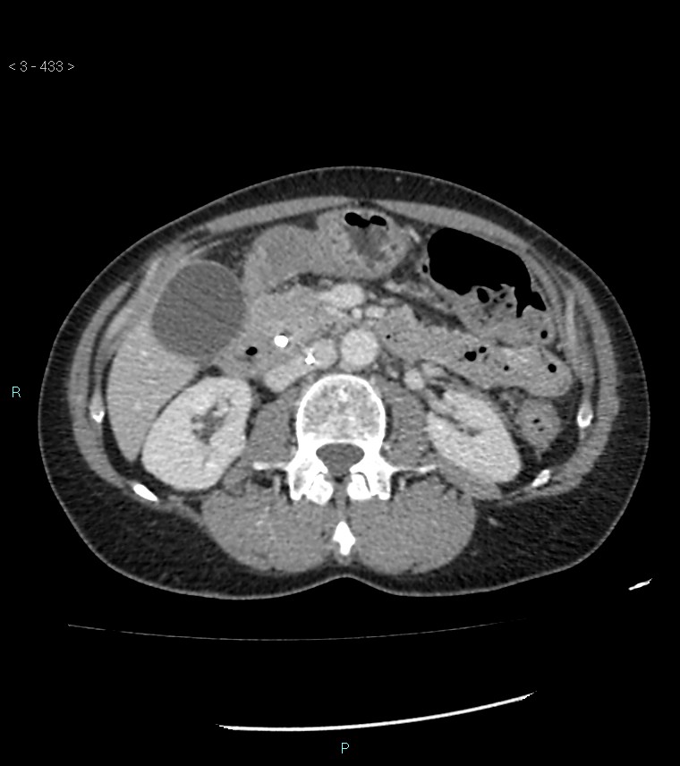 Ampulla of Vater metastasis (Radiopaedia 27820-28069 A 71).jpg