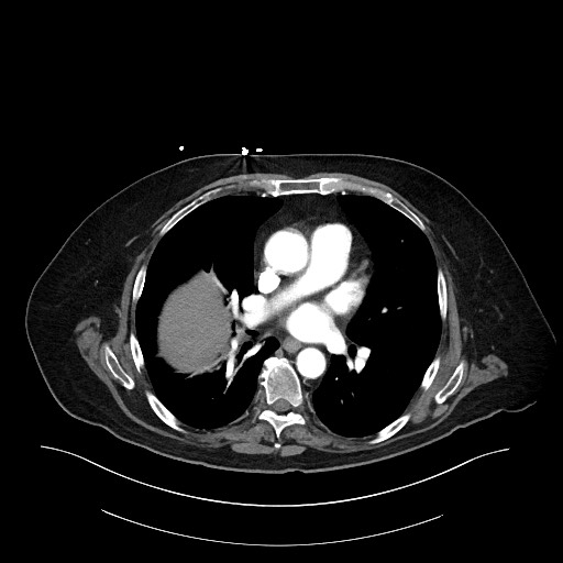 Ampullary adenocarcinoma (Radiopaedia 59373-66734 A 10).jpg