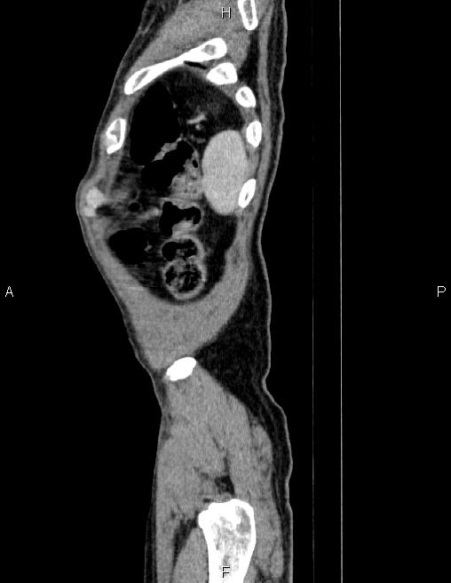 Ampullary adenocarcinoma (Radiopaedia 86093-102032 D 93).jpg