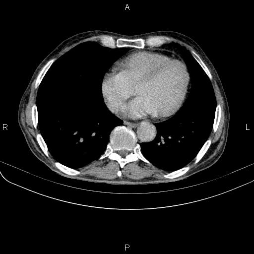 Ampullary adenocarcinoma (Radiopaedia 86093-102033 Axial C+ delayed 1).jpg