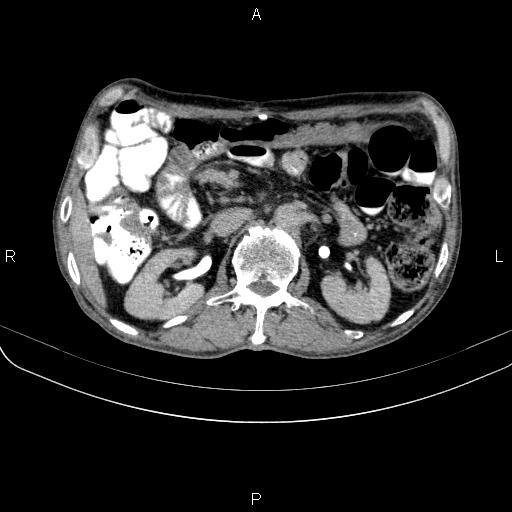 Ampullary adenocarcinoma (Radiopaedia 86093-102033 Axial C+ delayed 49).jpg